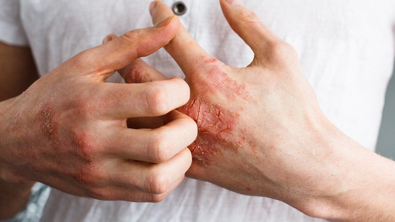 Photo for: Dry, Cracked Hands That Won’t Go Away? 5 Things to Know About Chronic Hand Eczema